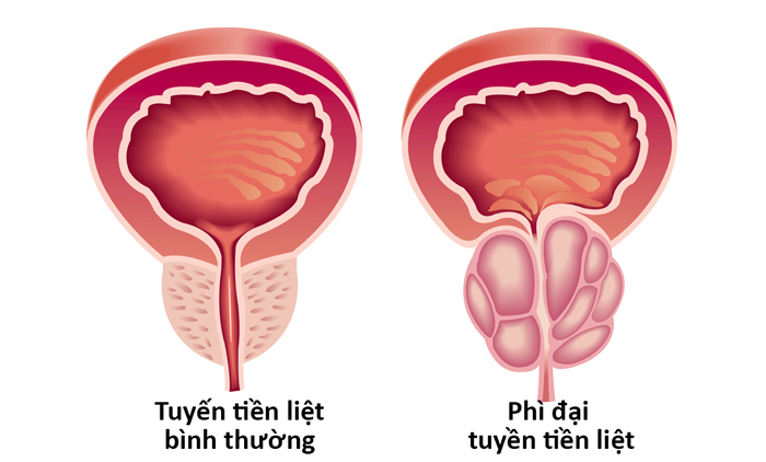 nước tiểu 2 dòng