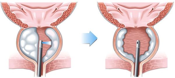 tuyến tiền liệt kích thước lớn