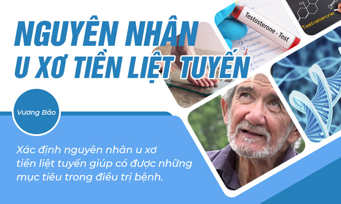 Nguyên nhân gây u xơ tiền liệt tuyến - Điểm danh Top!