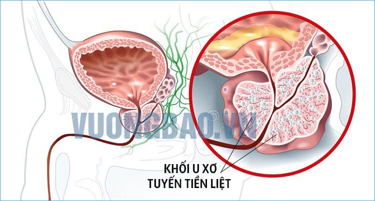 cách trị bí tiểu tại nhà