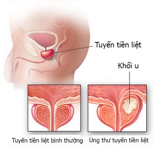 Chẩn đoán ung thư tuyến tiền liệt