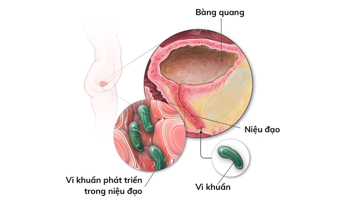 đi tiểu ra máu là bệnh gì