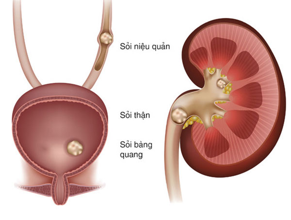 khó tiểu là bệnh gì