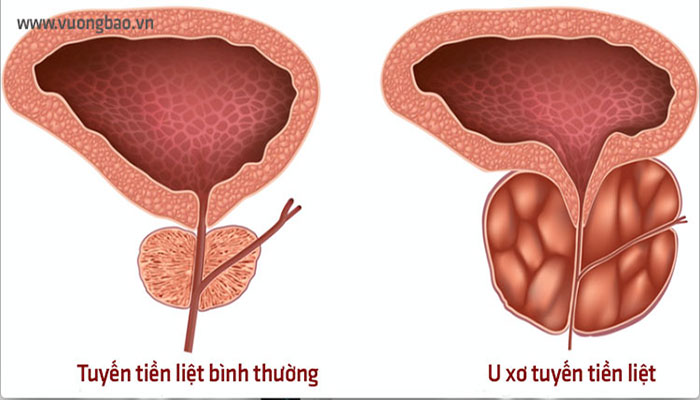 Bấm Huyệt Chữa Phì Đại Tuyến Tiền Liệt