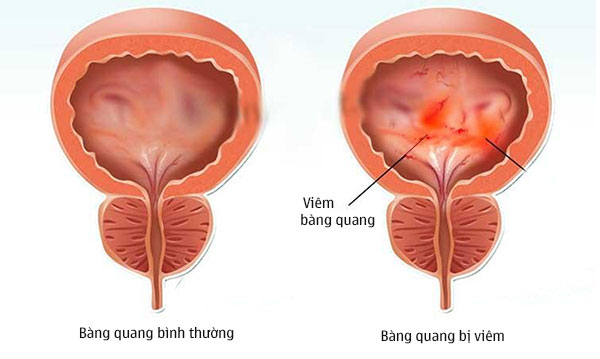 mắc tiểu liên tục nhưng tiểu ít ở nữ