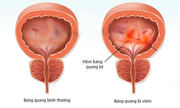 Nguyên nhân tiểu khó