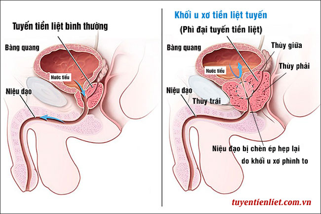 hình ảnh phì đại tuyến tiền liệt