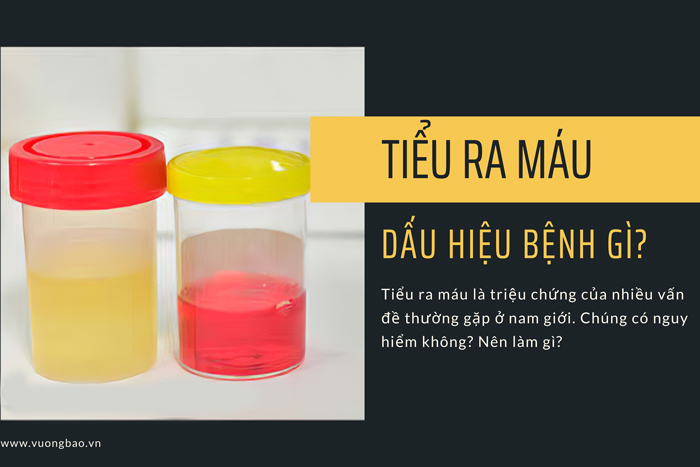 Đi Tiểu ra máu (Đái ra máu) nguy hiểm không? Cách điều trị