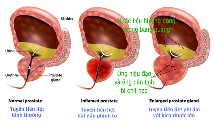 Hình ảnh phì đại tuyến tiền liệt cận cảnh nhất