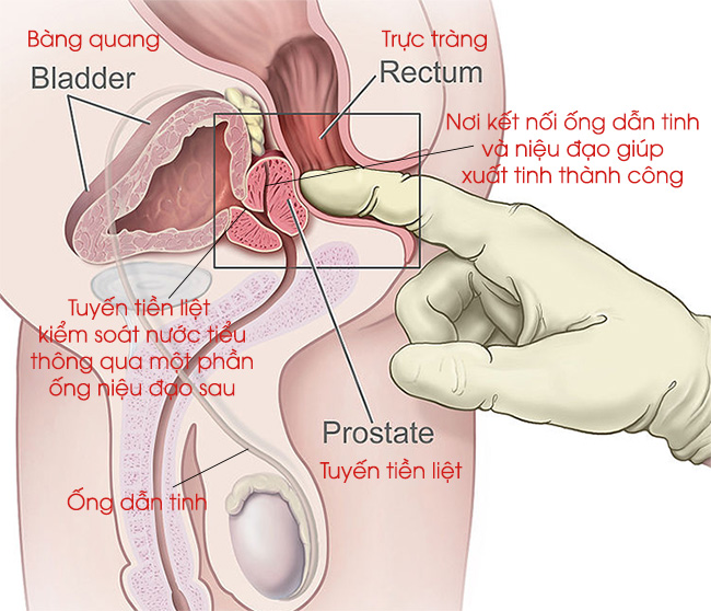 phì đại tuyến tiền liệt có nên quan hệ