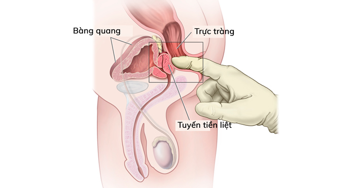 tiểu máu đại thể