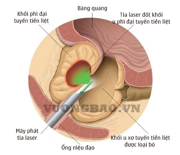 Điều Trị Phì Đại Tuyến Tiền Liệt