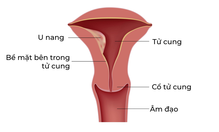 đi tiểu buốt ra máu