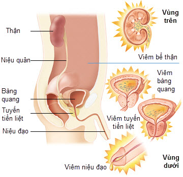 khi đi tiểu bị đau buốt ở nam