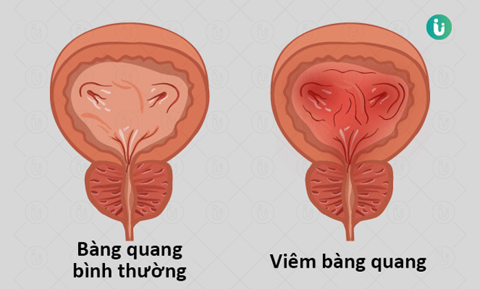 bí tiểu ở người cao tuổi