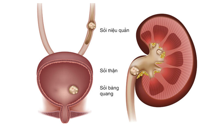 tiểu buốt tiểu ra máu ở nam giới