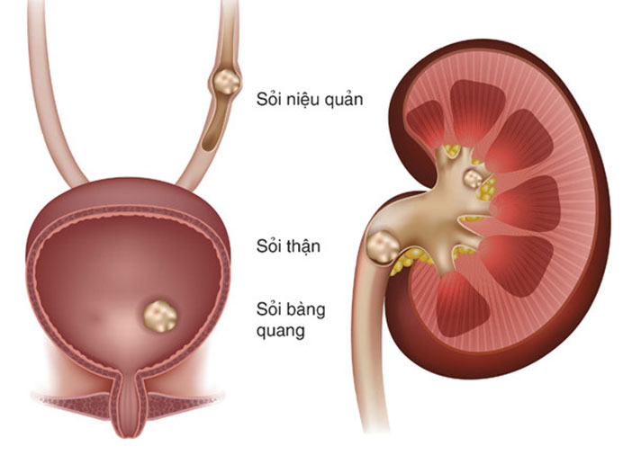 đi tiểu buốt ra máu