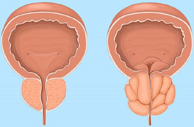 tiểu buốt ra máu uống thuốc gì