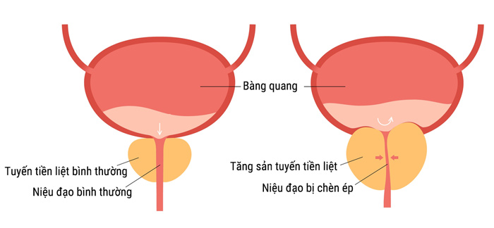 nguyên nhân tiểu đêm nhiều lần