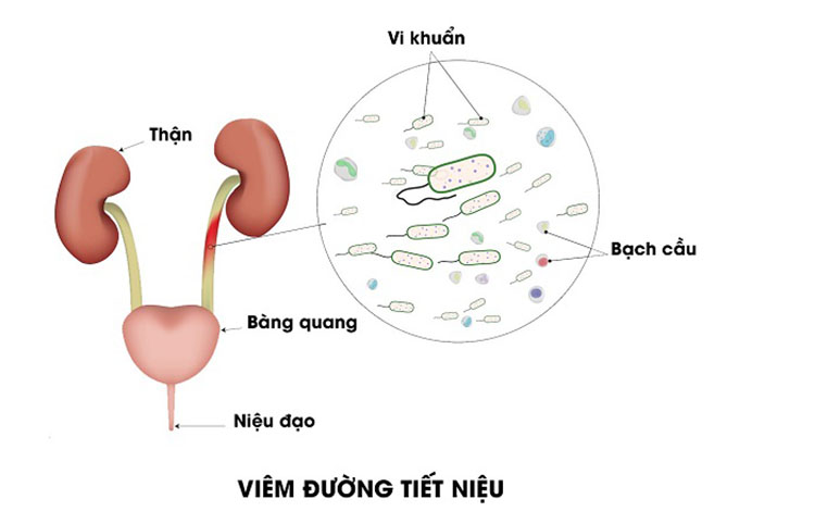 đi tiểu ngắt quãng