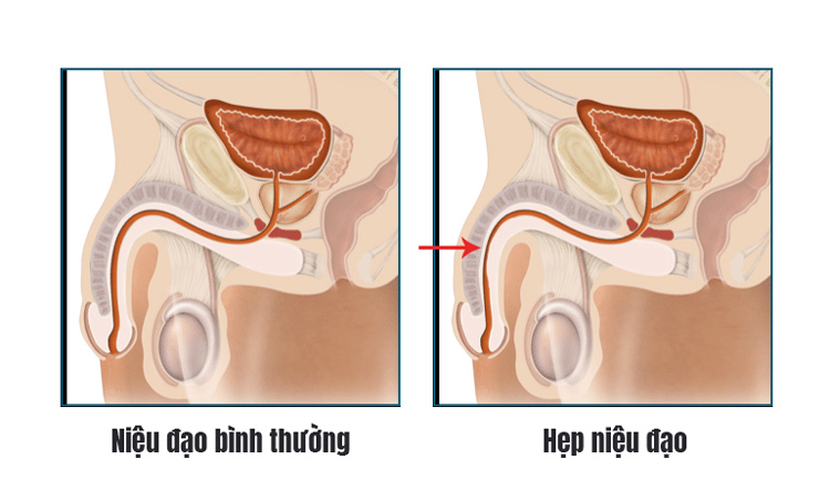 Tiểu nhiều tia bệnh gì