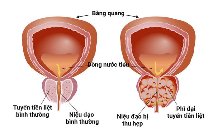 đi tiểu xong vẫn buồn tiểu