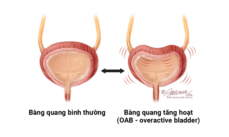 vừa tiểu xong lại mắc tiểu