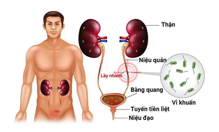 tiểu xong vẫn còn cảm giác buồn tiểu ở nữ