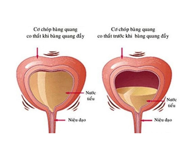 Mắc tiểu liên tục