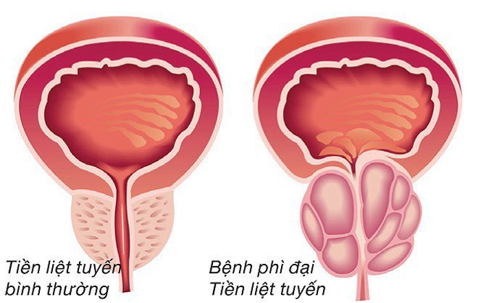 Kích thước tuyến tiền liệt