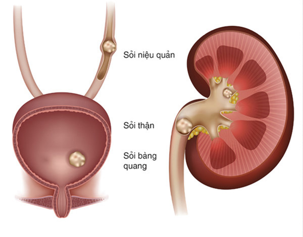 Tiểu ra máu ở nam giới