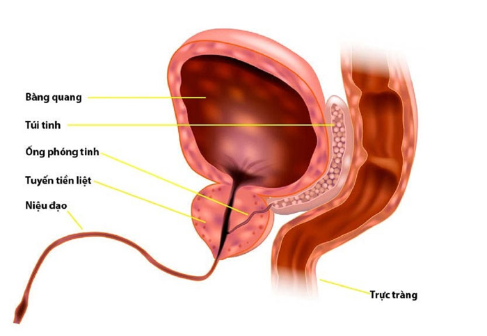 sỏi tiền liệt tuyến