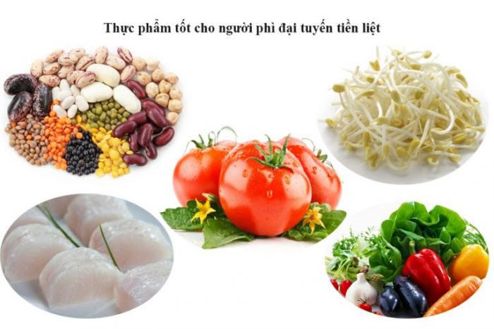 Phì đại tuyến tiền liệt nên ăn gì? Kiêng gì? Ngăn biến chứng