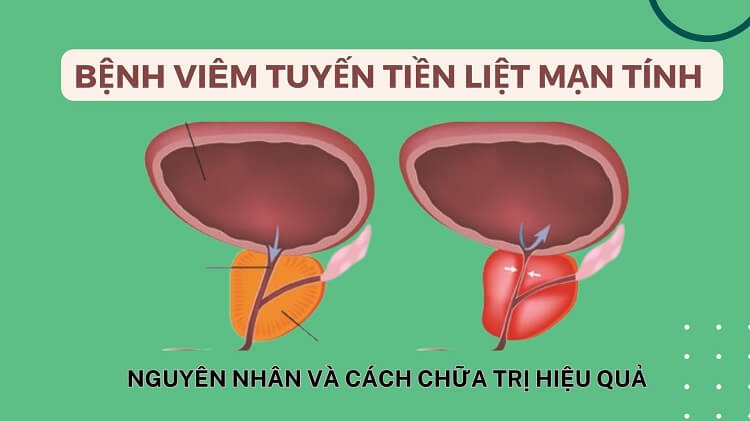 Viêm tuyến tiền liệt mãn tính là gì? có nguy hiểm không?